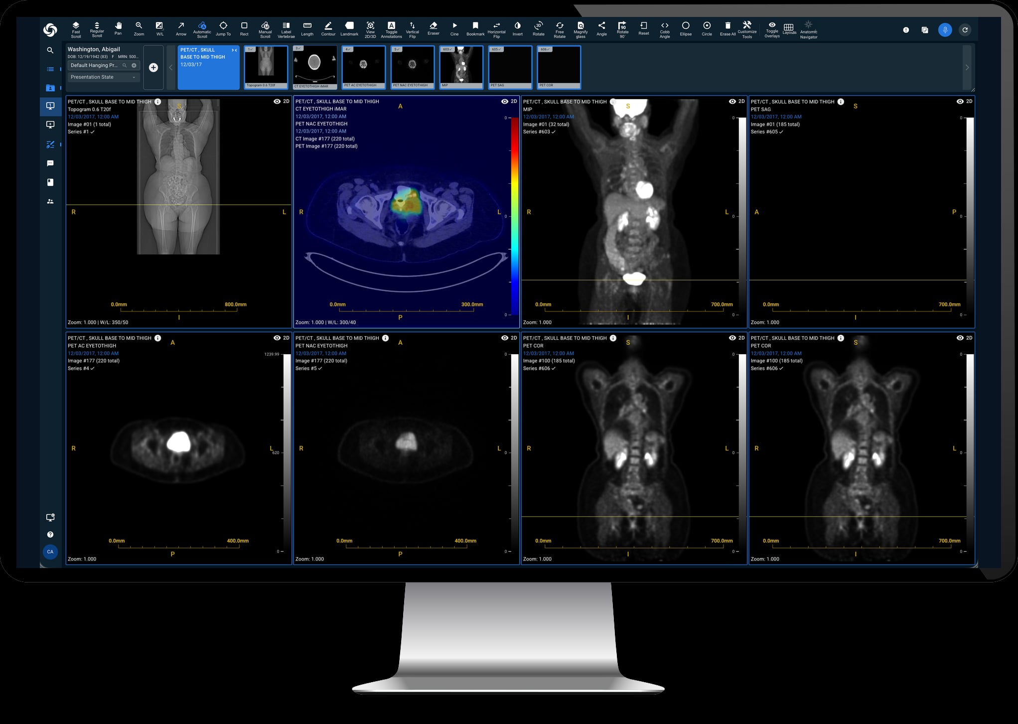 Sirona diagnostic viewer (PET/CT) on a desktop monitor